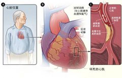 冠心病的起因是什么？