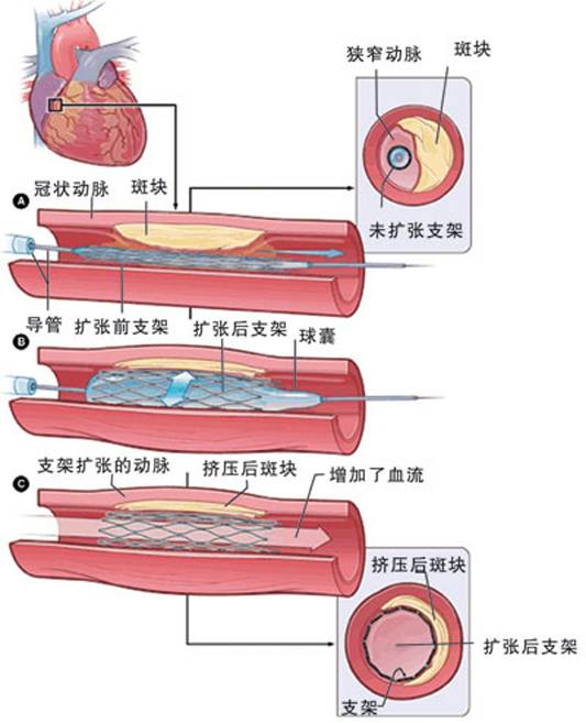 怎樣治療冠心?。?圖2)