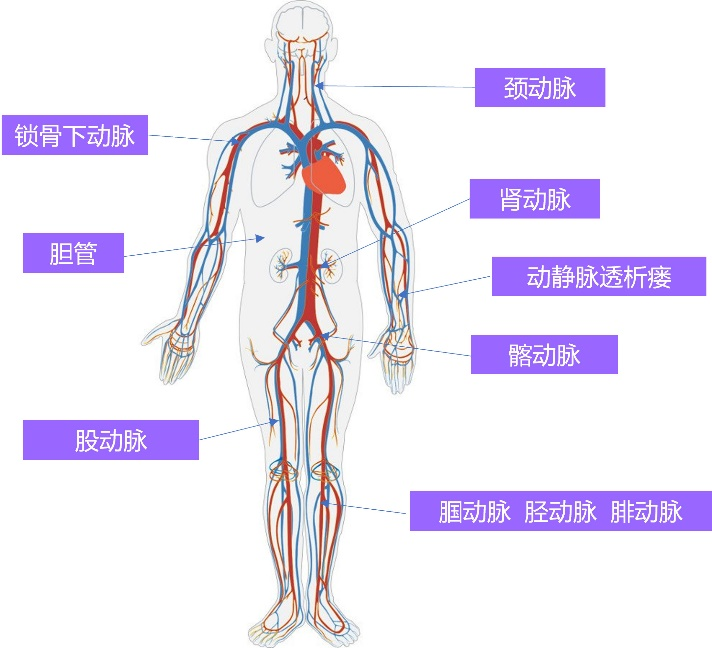 周游? Voyaging?球囊擴張導(dǎo)管(圖3)